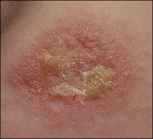 Photo of an eczema lesion.